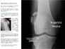 Bipartite Patella Information