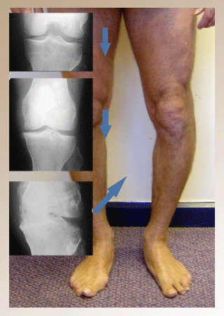 OA Knee